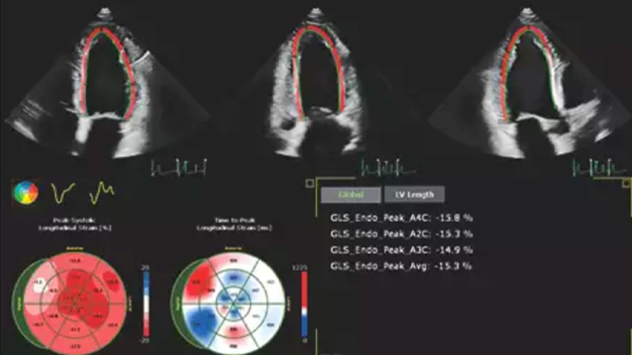 Imagen que muestra los resultados de la automatizaci&oacute;n para una cuantificaci&oacute;n cardiaca s&oacute;lida y reproducible tanto en 2D como en 3D
