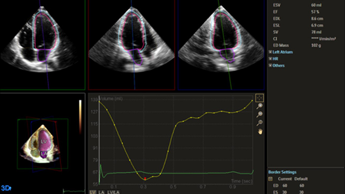 Imagen que muestra la cuantificaci&oacute;n a trav&eacute;s de Dynamic HeartModel de Philips