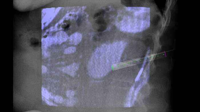 Guiado de la trayectoria de la aguja con XperGuide