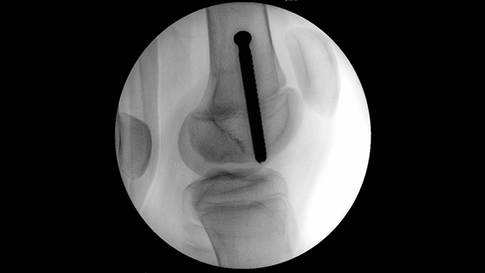 MetalSmart excluye los artefactos met&aacute;licos