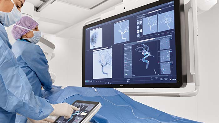 Tratamiento de aneurisma cerebral