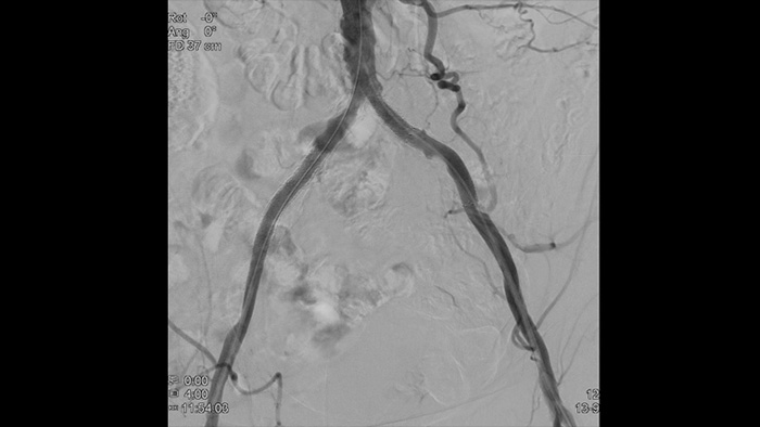 Vasos vistos con tecnolog&iacute;a ClarityIQ