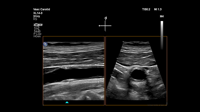 Ejemplo de una imagen recuperada con la ecograf&iacute;a vascular Xplane Imaging de Philips