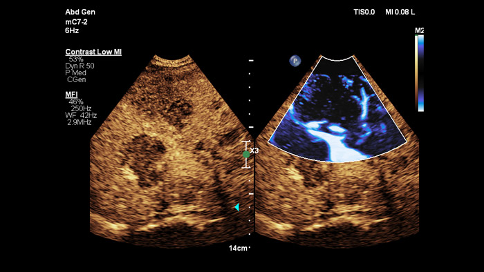 IMF con contraste EPIQ vm9 MC7
