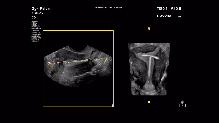 Imagen en miniatura para el v&iacute;deo FlexVue
