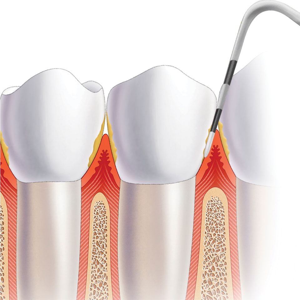 Imagen cl&iacute;nica de periodontitis