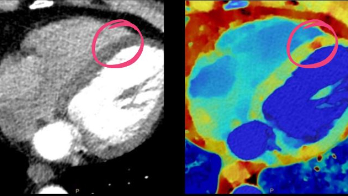 Spectral CT