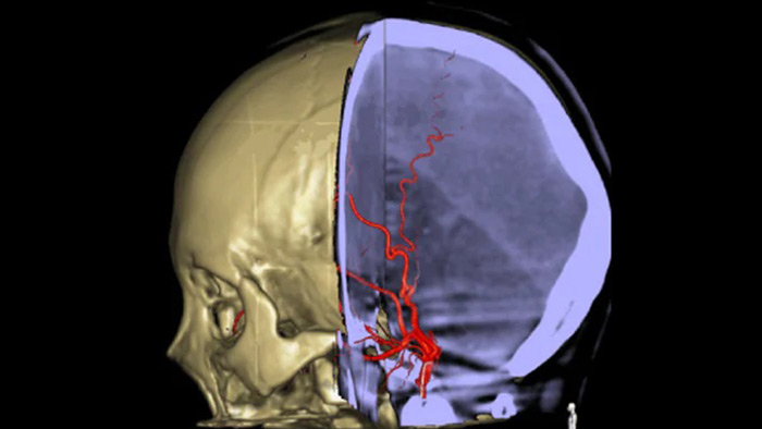 Navegaci&oacute;n 3D precisa con SmartCT Roadmap