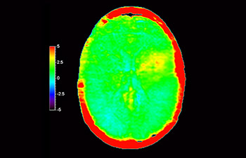Lesi&oacute;n cerebral