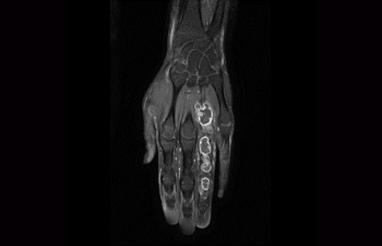 Tumor en mano/mu&ntilde;eca